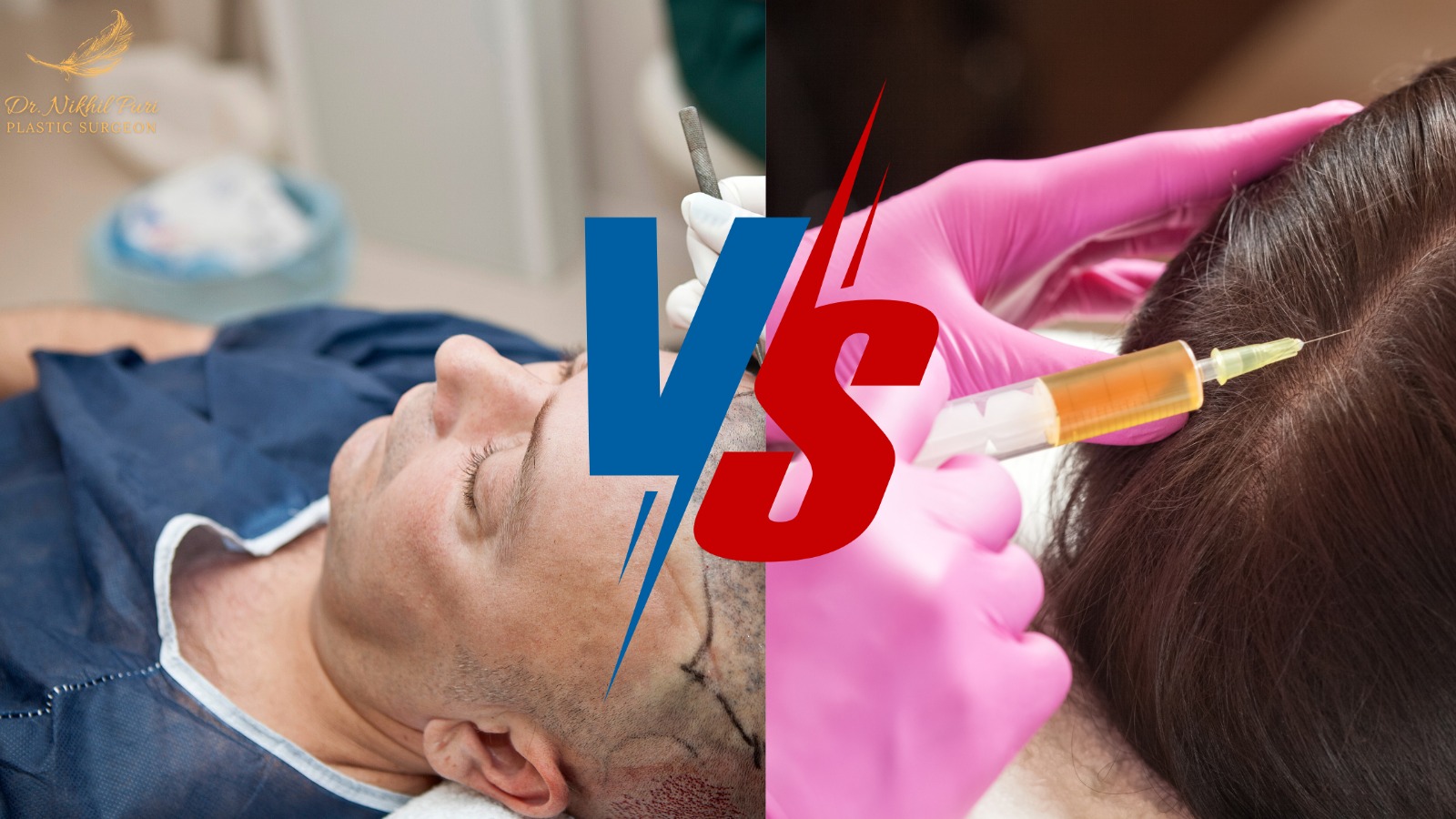 PRP vs Hair Transplant: Which is Best for You in Lucknow?