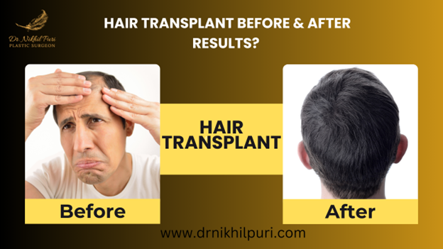Hair Transplant Lucknow: Before & After Results by Dr. Nikhil Puri