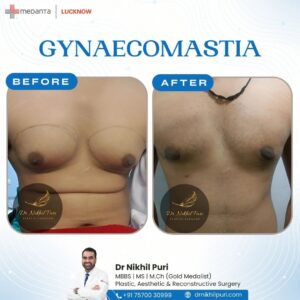 Gynaecomastia surgery in lucknow -Dr Nikhil puri