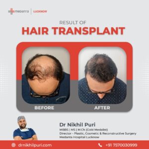 Before and after FUE hair transplant in Lucknow demonstrating natural growth and improved hairline design.
