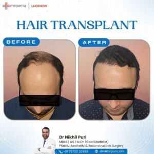 Before and after hair transplant results by Dr. Nikhil Puri in Lucknow showing increased density and natural hairline.