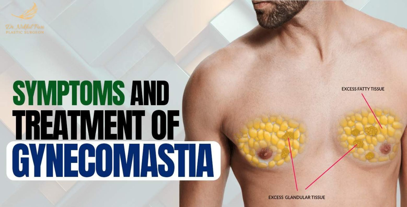 Gynecomastia: Types, Symptoms, Diagnosis, and Treatment