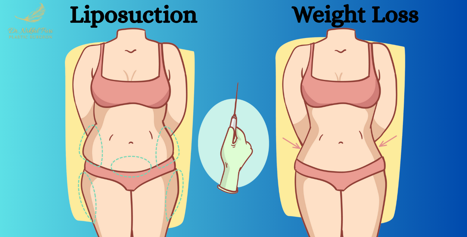 Liposuction vs. Weight Loss: What’s the Difference?