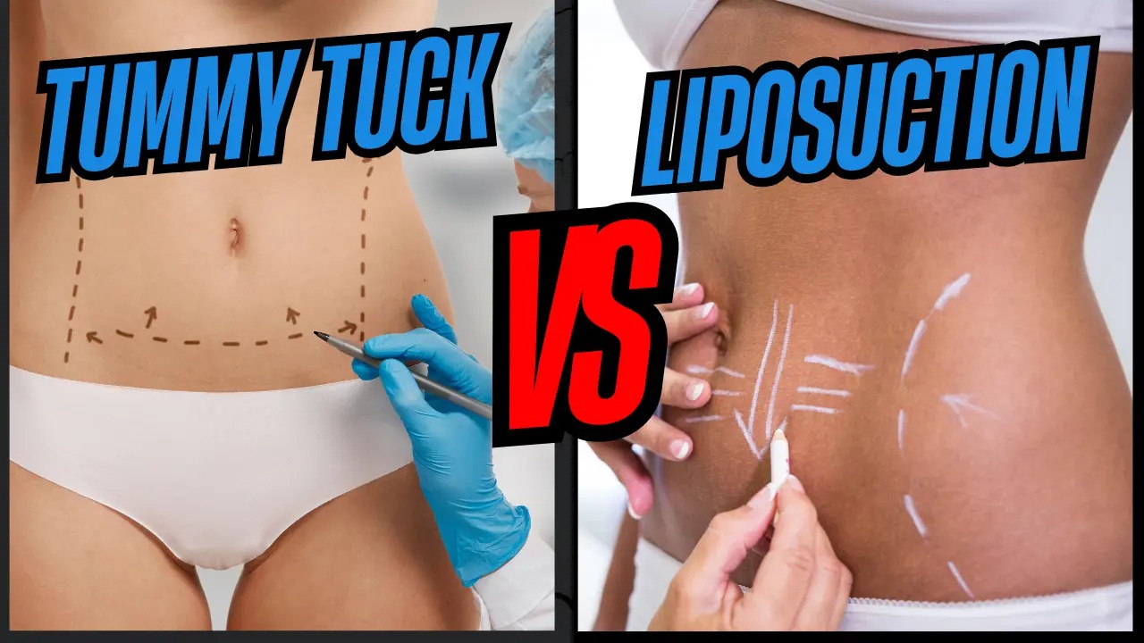 Tummy Tuck vs Liposuction: Procedure, Recovery & Results Compared