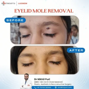 Best Eyelid Surgery in India 2026 | Blepharoplasty by Top Surgeons