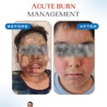 Acute burn treatment performed by dr nikhil puri
