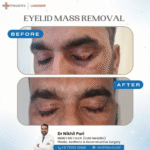 Before and after results of eyelid mass removal surgery performed by Dr. Nikhil Puri, Plastic, Aesthetic & Reconstructive Surgeon in Lucknow, showing successful excision and natural eyelid appearance.