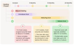 Gynecomastia scar healing और सर्जरी के बाद निशान का समय के साथ हल्का होने की प्रक्रिया
